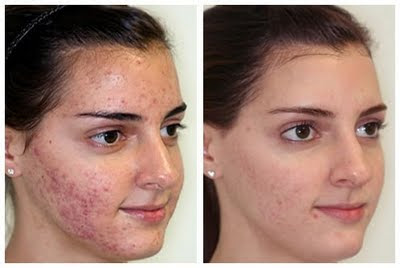 Microdermabrasion Delhi