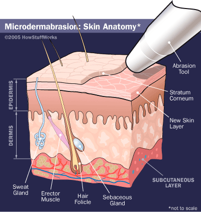 Microdermabrasion Delhi