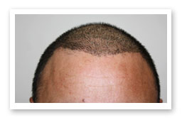 Consultation for Hair Loss